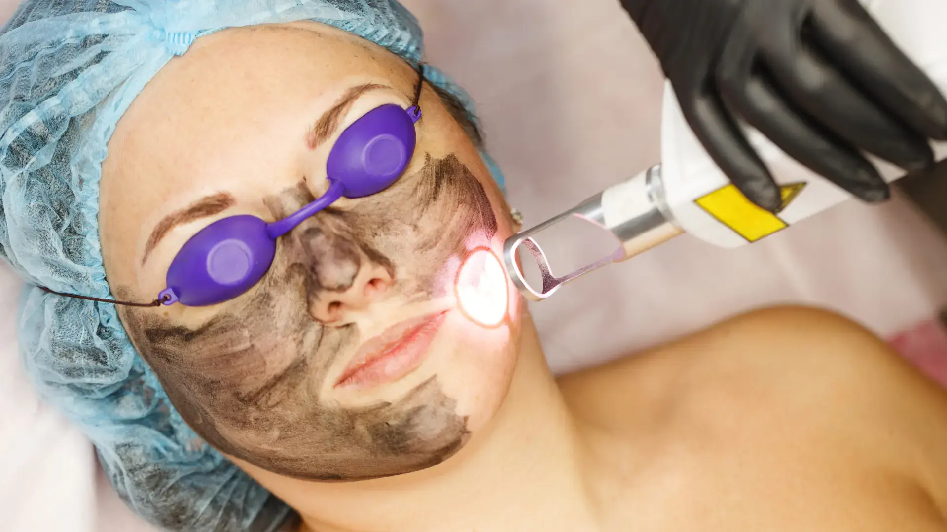 Carbon Laser Facial & Treatment Gorgaon Mumbai